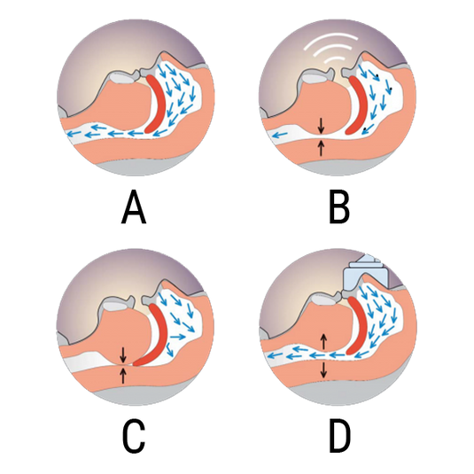 Sleep Apnea – Air Liquide Healthcare
