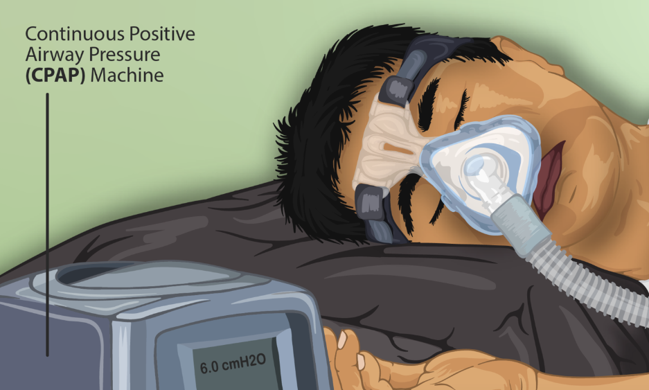 How Do Sleep Apnea Machines Work? 