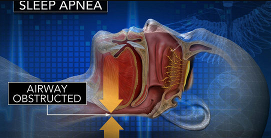 How To Know If You Have Sleep Apnea?