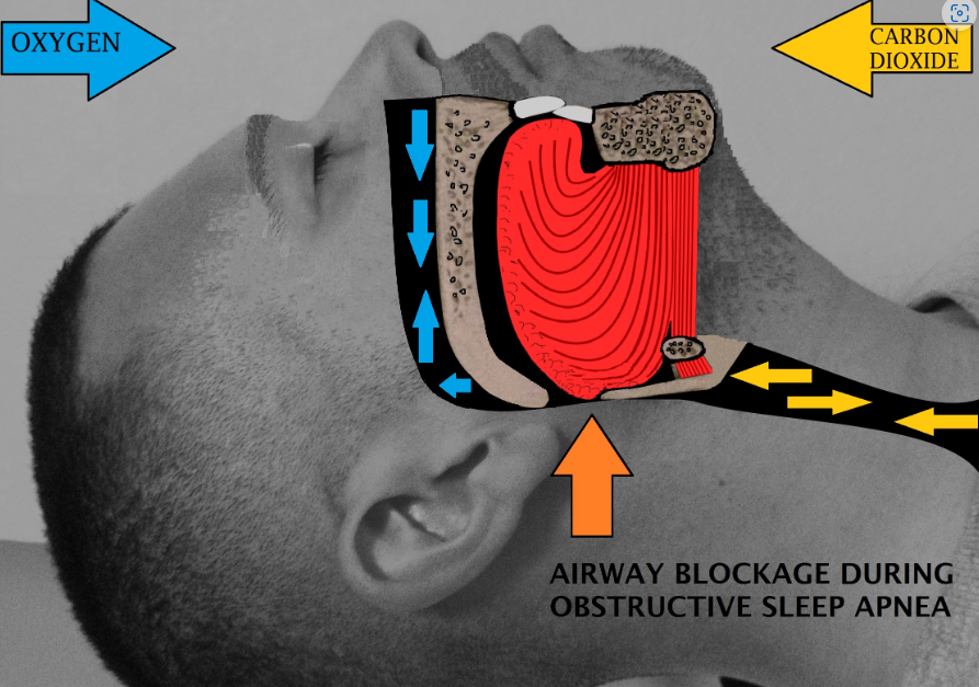 What Are The Causes Of Sleep Apnea? 