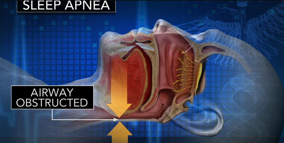 What Are The Symptoms For Sleep Apnea?