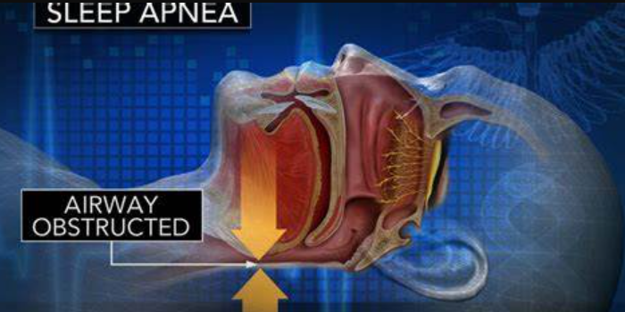 What Are CPAP Masks?